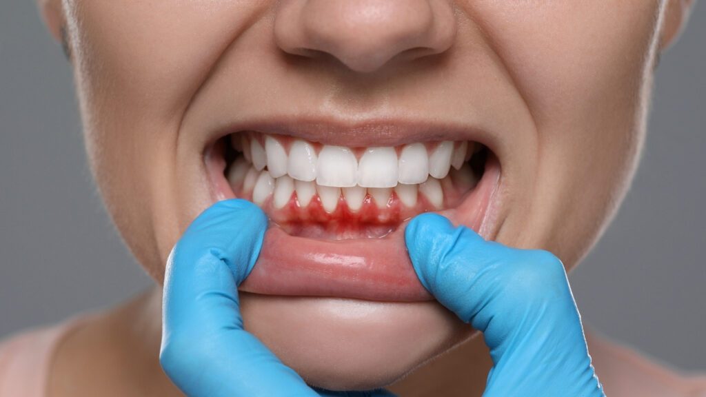 How Gum Graft Surgery Helps Treat Receding Gums