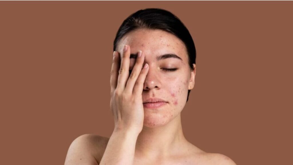 Tips for Building a Routine with Acne Treatment and Ageing Products